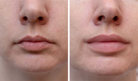 Lip filler moncton  We use hyaluronic acid-based fillers for fuller, luscious, natural lips